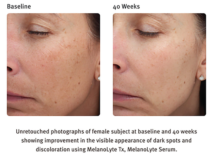 MelanoLyte Tx